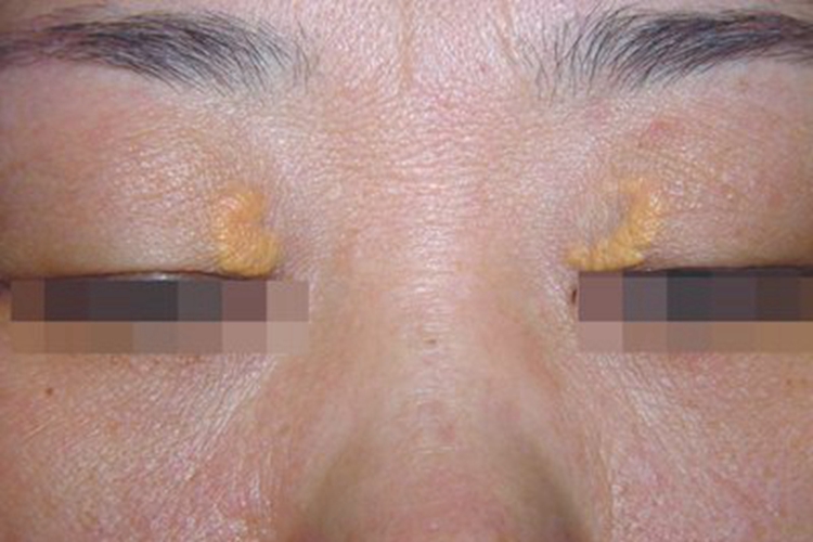 睑黄瘤症状图 睑黄瘤症状图