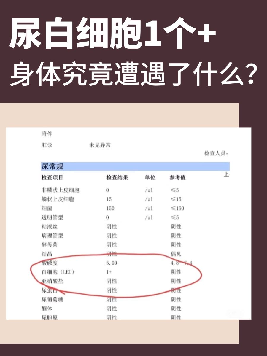 尿白细胞1个+,身体究竟遭遇了什么?