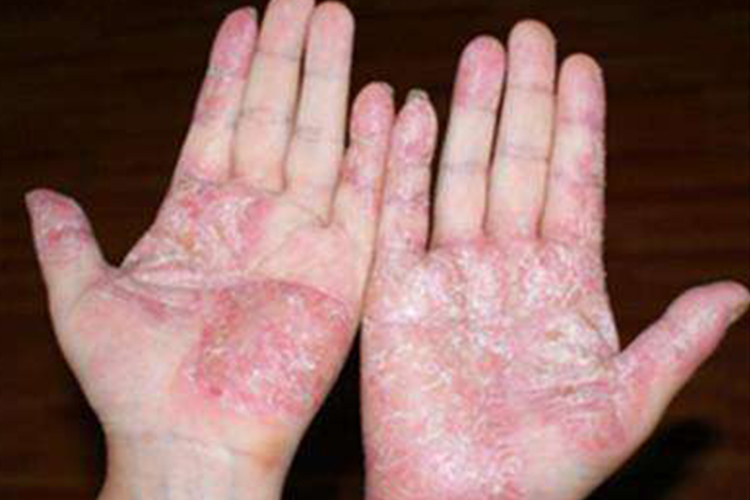 艾滋病鳞屑角化型手癣图