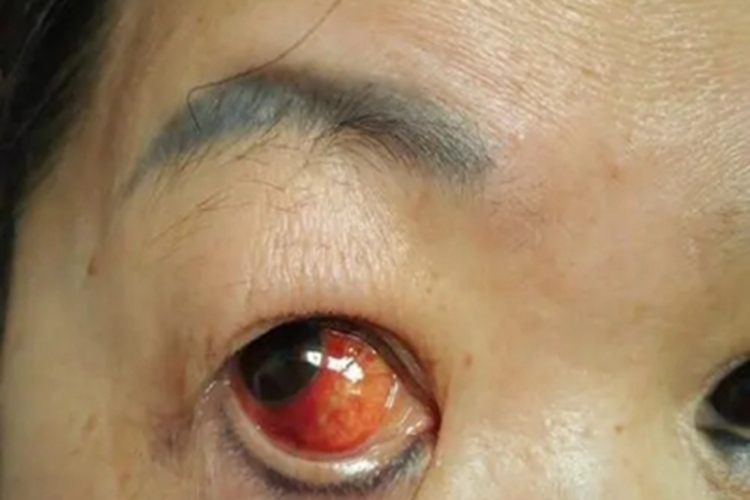 病毒性结膜炎眼球红肿图