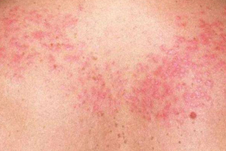 寻常狼疮背部红斑成片图
