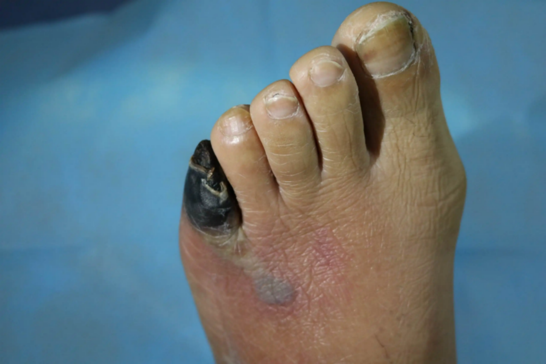 足部坏疽样改变图 足部坏疽样改变图