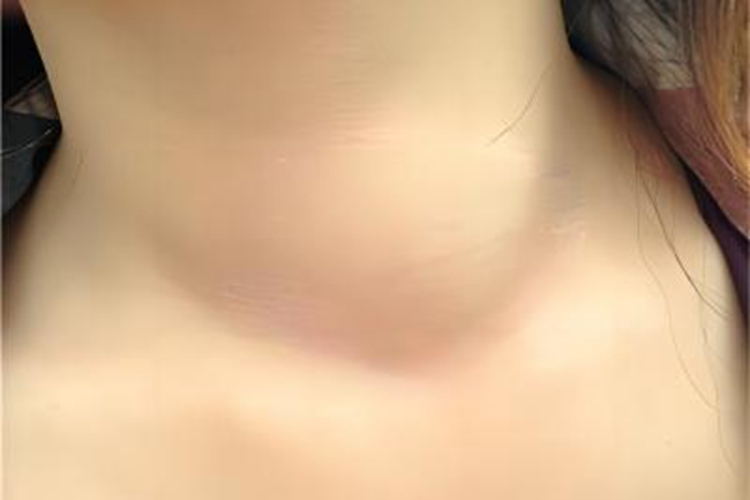 樊尚咽峡炎前颈症状图 樊尚咽峡炎前颈症状图