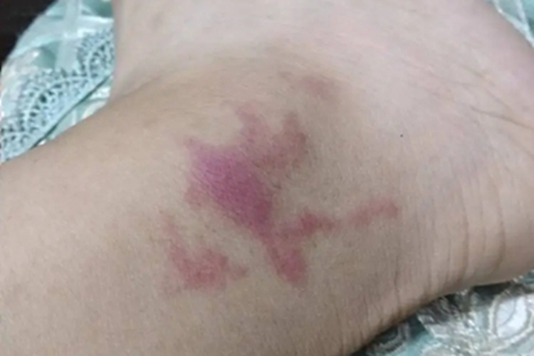 特发性网状青斑症状图