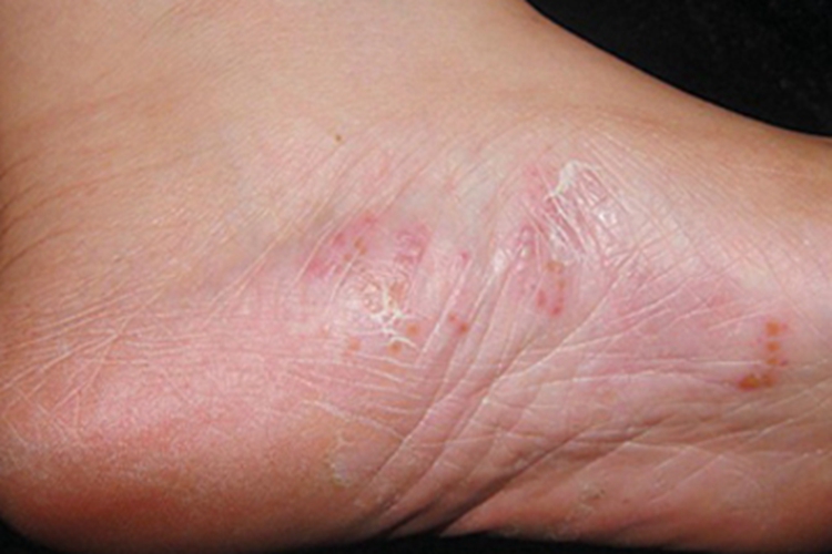 水疱型足癣脚部症状图 水疱型足癣脚部症状图