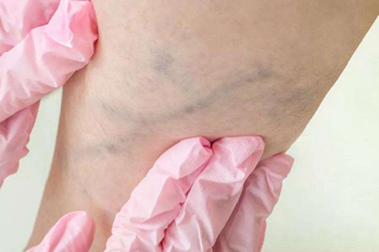 下肢静脉曲张大腿症状图 下肢静脉曲张大腿症状图