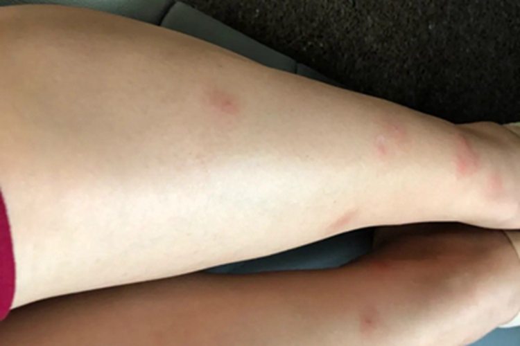 硬红斑小腿有红色结节图