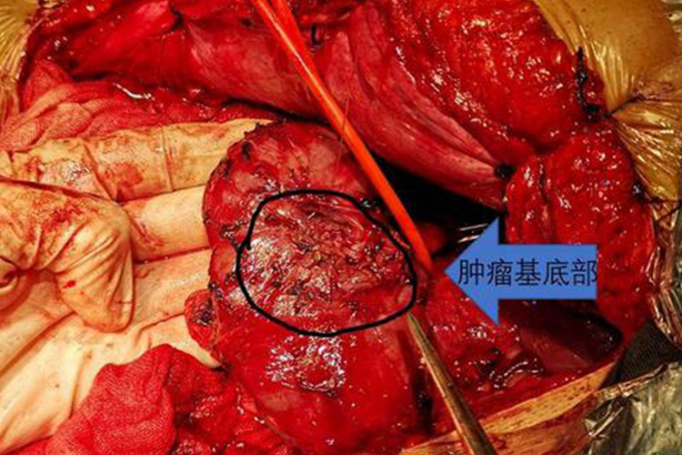 肾肿瘤切除术图 肾肿瘤切除术图