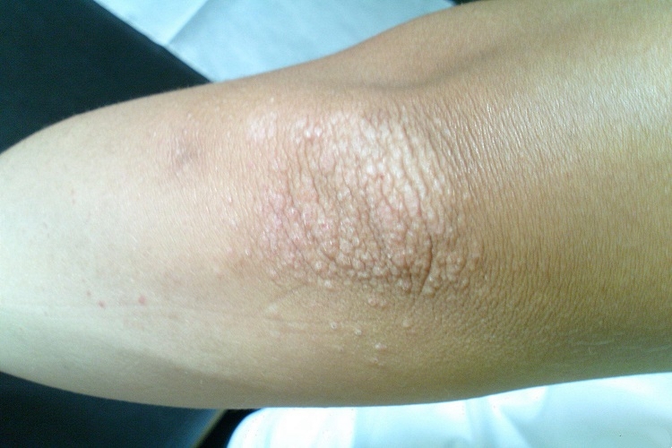 光泽苔藓肘部症状图