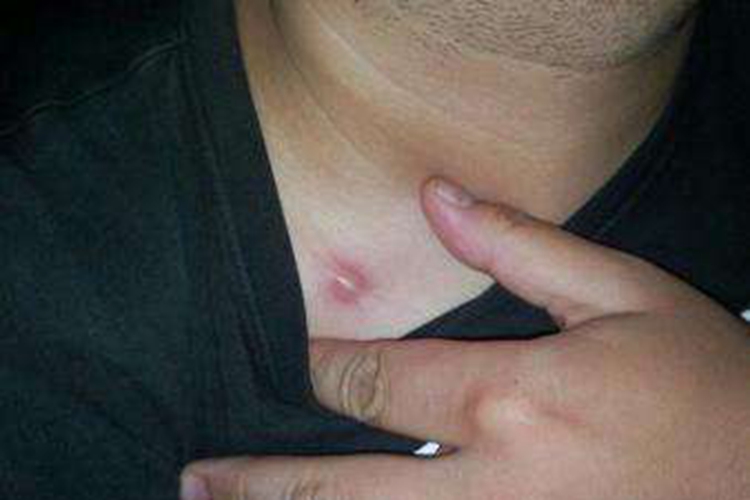 皮脂腺囊肿图 皮脂腺囊肿图