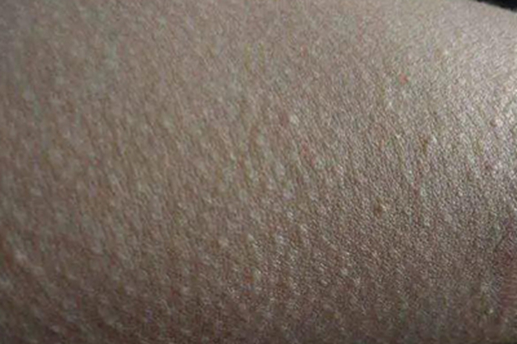 大腿内侧毛周角化病图