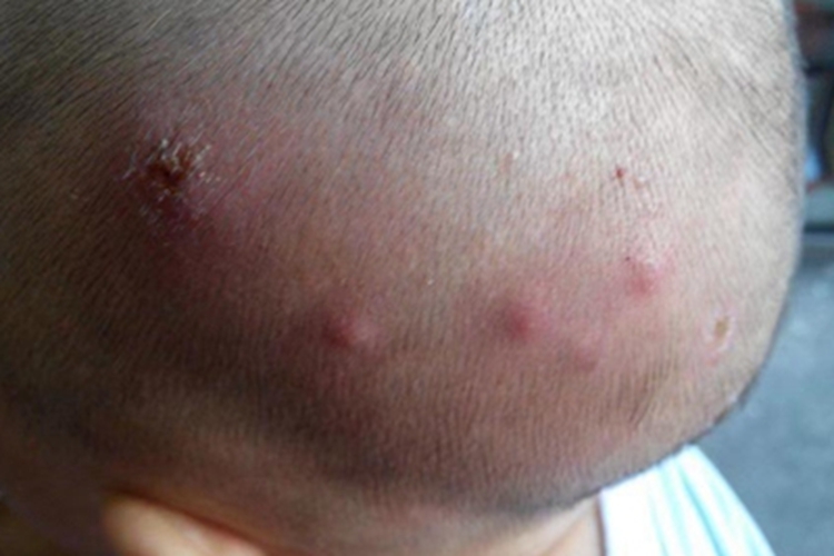 非大疱型脓疱疮头皮小红疙瘩图 非大疱型脓疱疮头皮小红疙瘩图