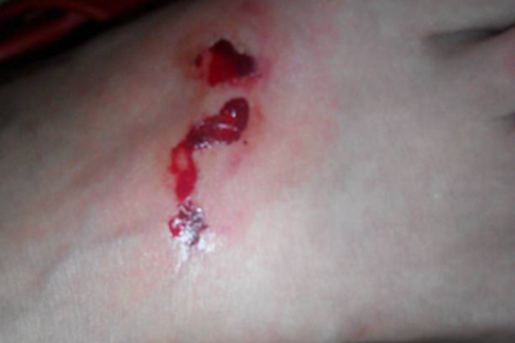 蛇咬伤脚背症状图