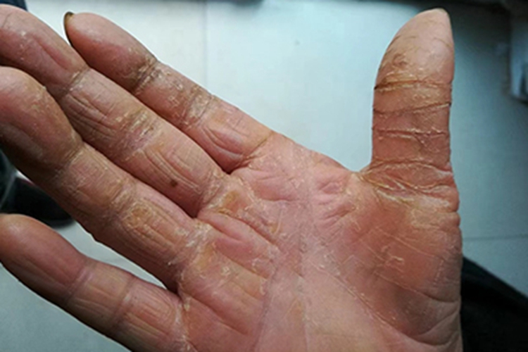 皲裂性湿疹手部皮肤增厚图