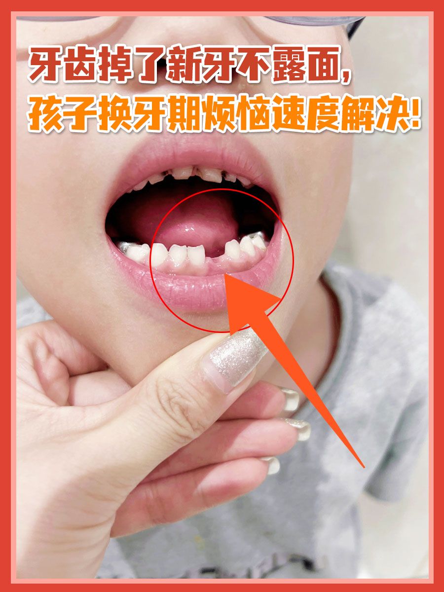 牙齿掉了新牙不露面，孩子换牙期烦恼速度解决！