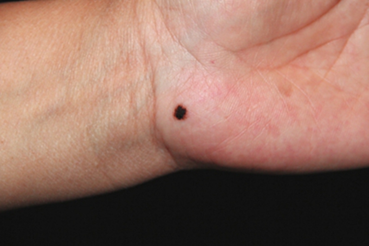 交界痣手掌黑痣图