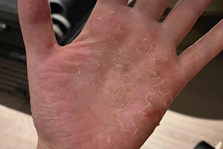 汗疱疹手掌脱皮图 汗疱疹手掌脱皮图