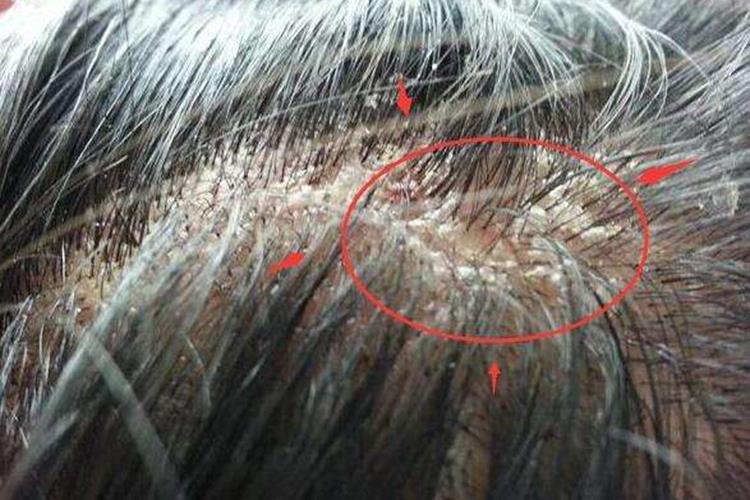 头皮脂溢性皮炎图