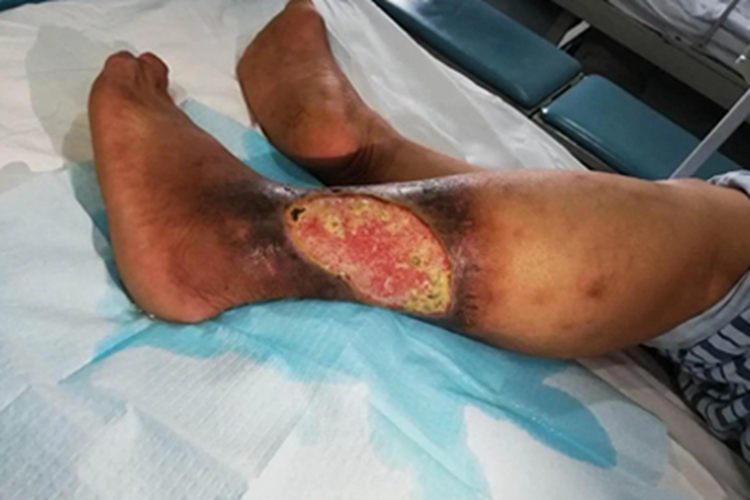 下肢深静脉血栓形成化脓图