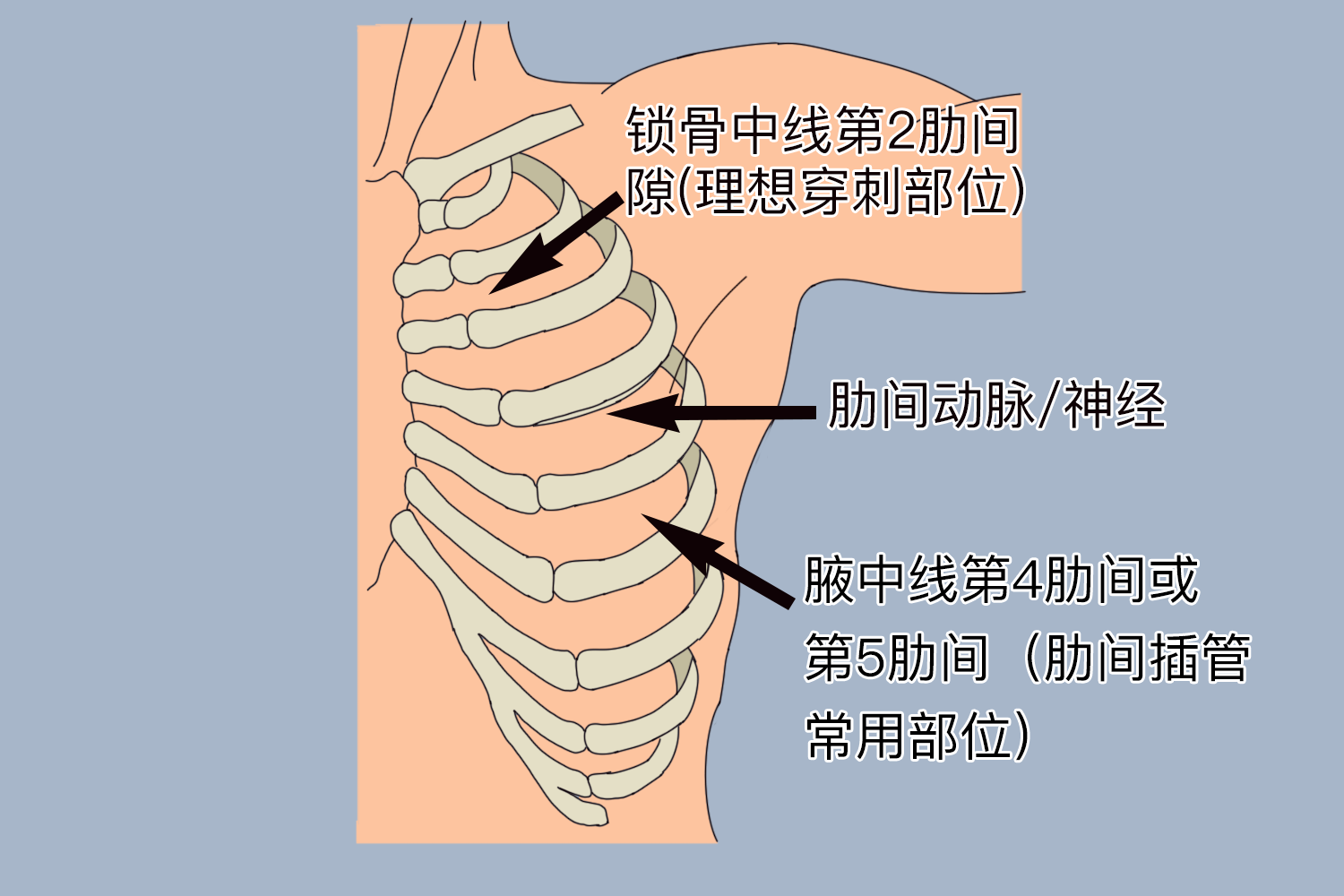 气胸穿刺部位图