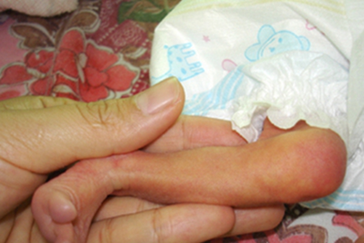 新生儿硬肿症小腿肿图 新生儿硬肿症小腿肿图