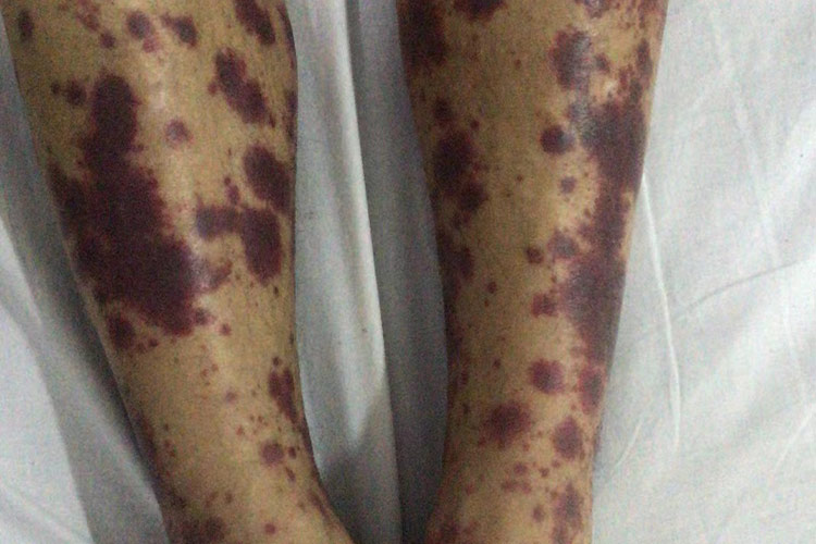 融合成片的紫癜图