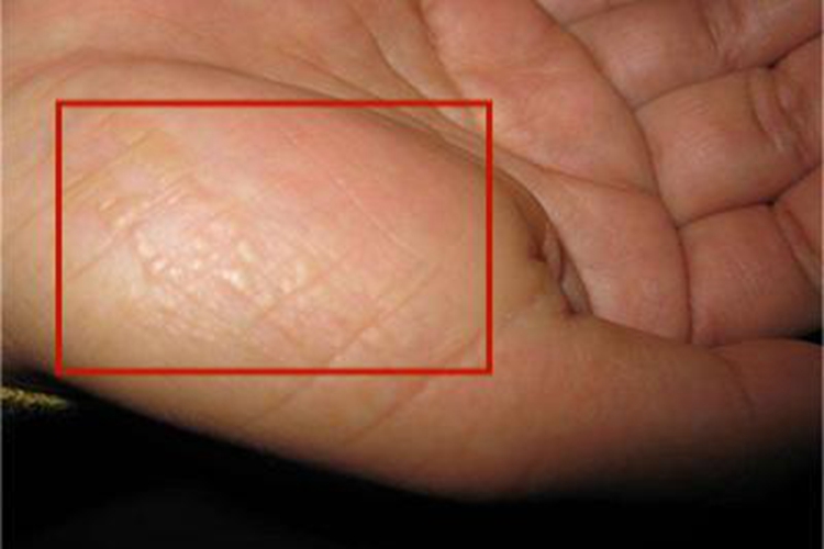 点状掌跖角化病手掌皮肤增厚图 点状掌跖角化病手掌皮肤增厚图