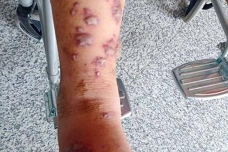 臁疮小腿症状图 臁疮小腿症状图