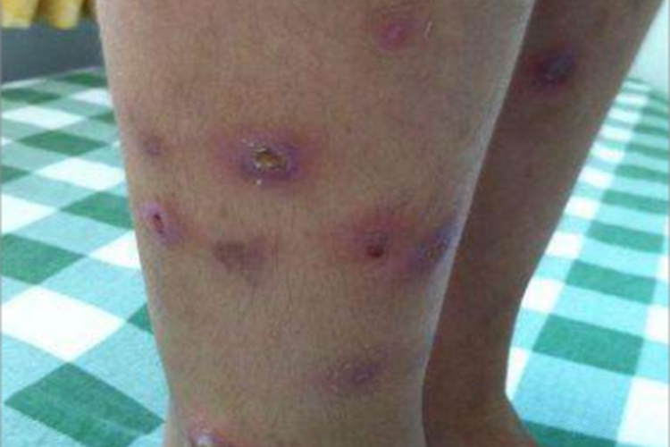 变应性皮肤结节性血管炎症状图 变应性皮肤结节性血管炎症状图