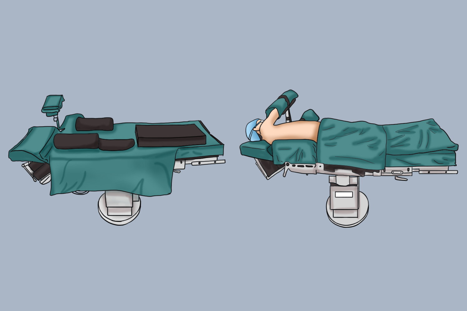 腹腔镜肝右后叶切除术左侧卧位安置图