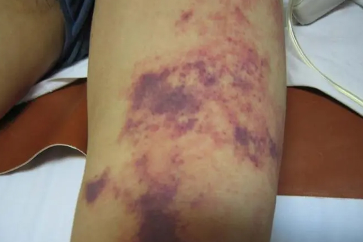 流行性出血热图