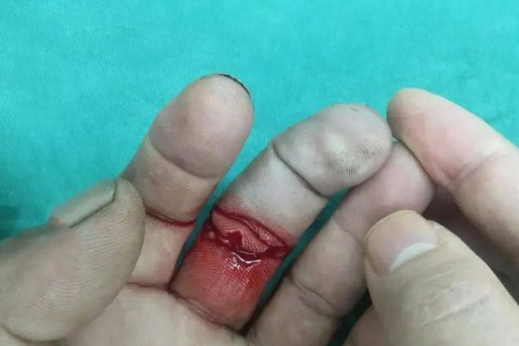手指开放性损伤图