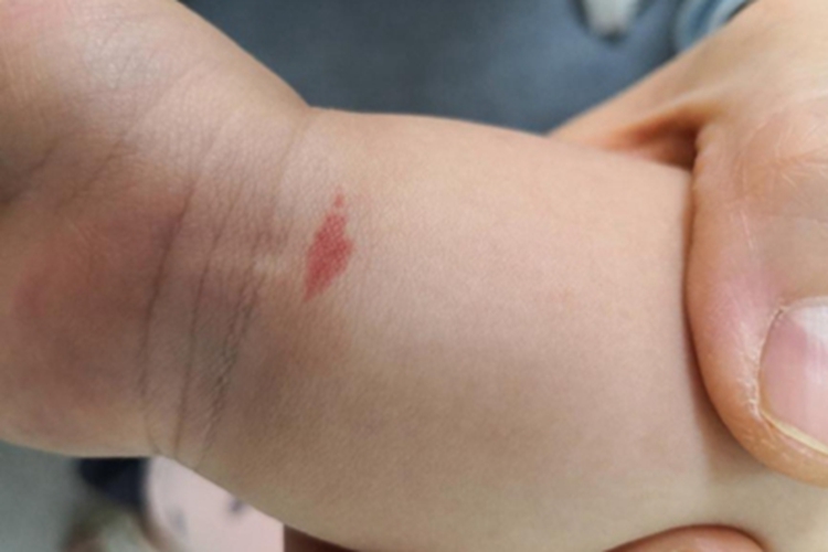 血管型胎记手腕红斑图 血管型胎记手腕红斑图