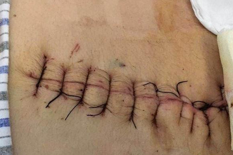 开腹子宫切除术术后图