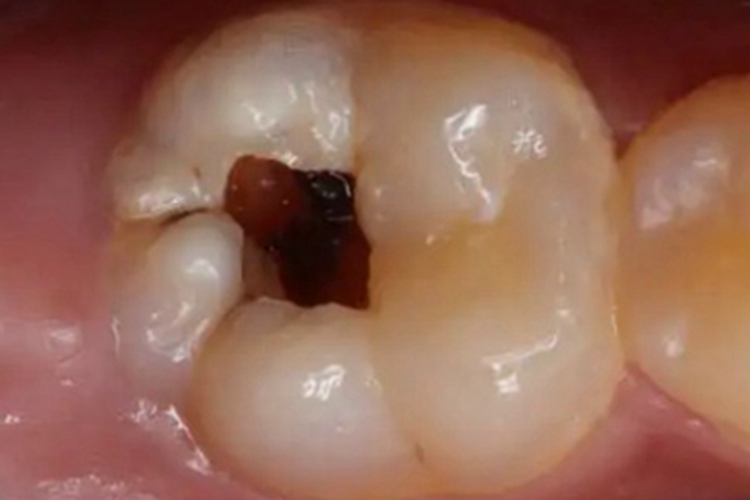 深龋牙齿症状图 深龋牙齿症状图