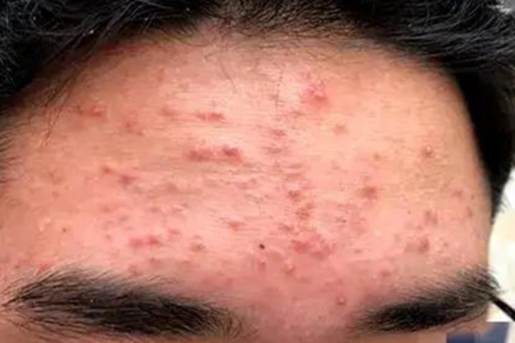 痤疮额头一片红疙瘩图