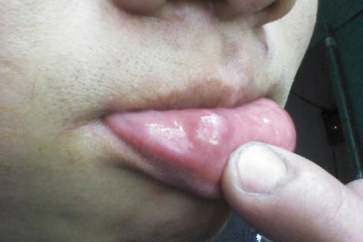 下嘴唇内壁纤维瘤图