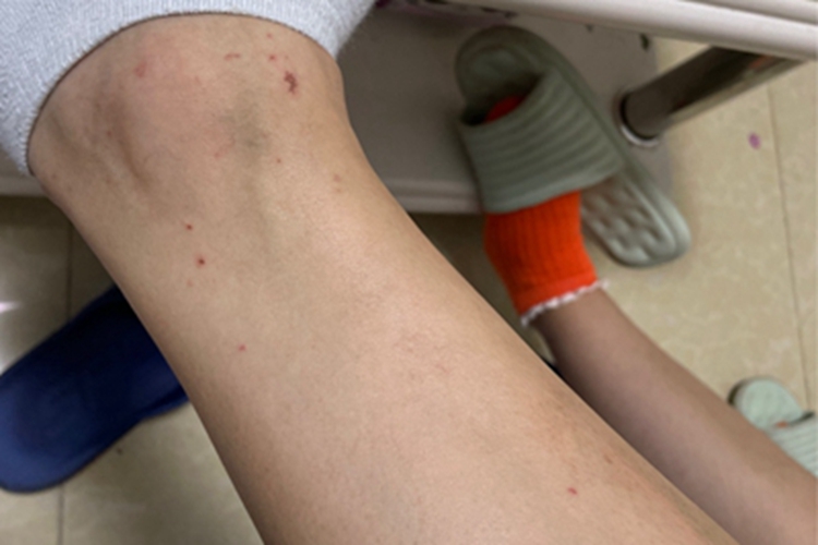 虫咬皮炎脚踝血痂图