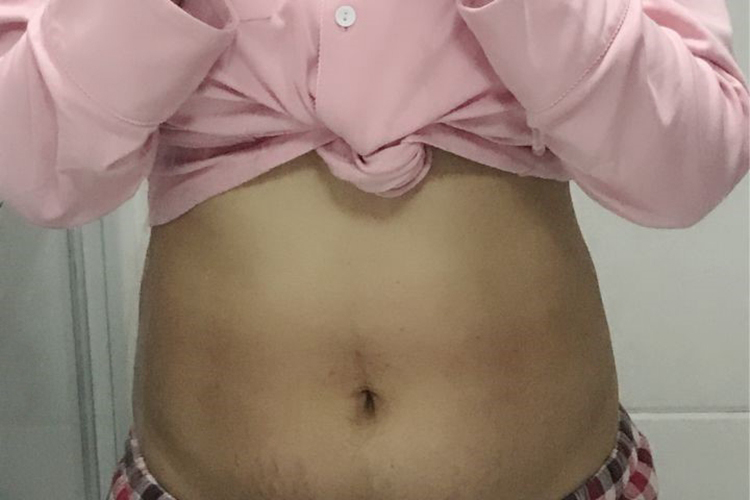 顺产完的肚子图 顺产完的肚子图