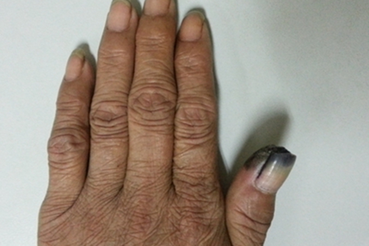 肢端雀斑痣样黑素瘤手指甲黑斑图 肢端雀斑痣样黑素瘤手指甲黑斑图