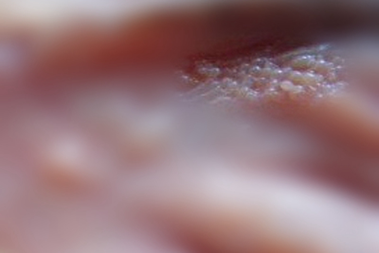 女性生殖器疱疹小疙瘩图 女性生殖器疱疹小疙瘩图