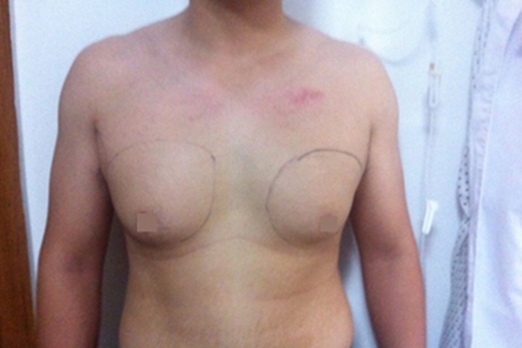 男性乳房肥大症增大图 男性乳房肥大症增大图