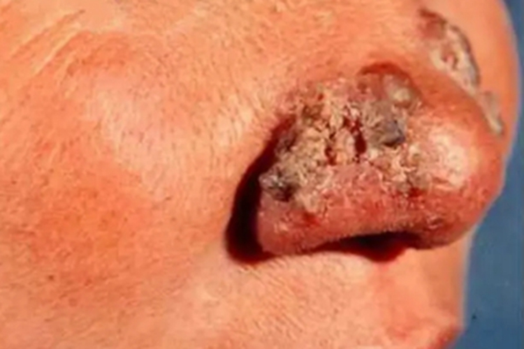 慢性黏膜皮肤念珠菌病鼻翼厚痂图