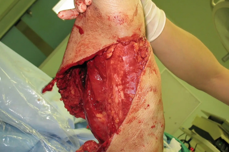 开放性脱套伤图 开放性脱套伤图