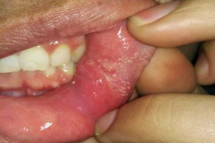 皮脂腺异位症口腔丘疹图