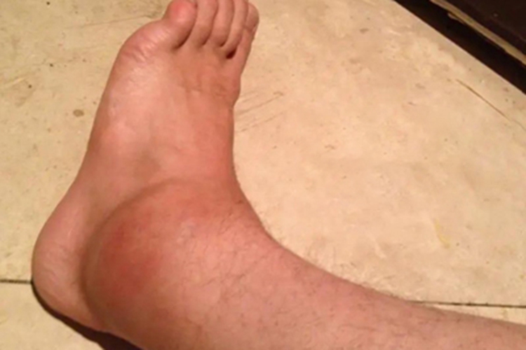 踝扭伤脚踝红肿图 踝扭伤脚踝红肿图