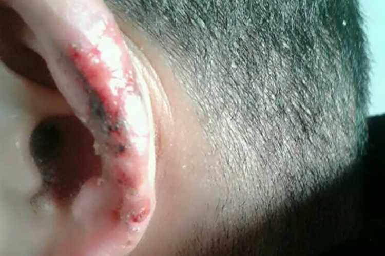 重度坏死性冻疮图