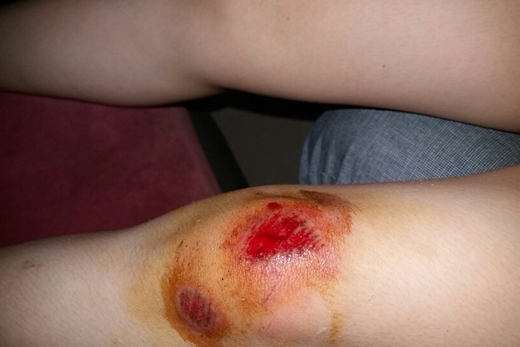 膝盖开放性软组织损伤图