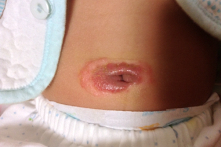 脐窝湿疹肚脐红肿图 脐窝湿疹肚脐红肿图