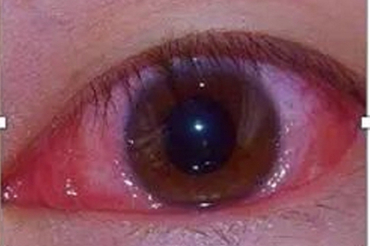 干燥综合征眼睛充血图 干燥综合征眼睛充血图